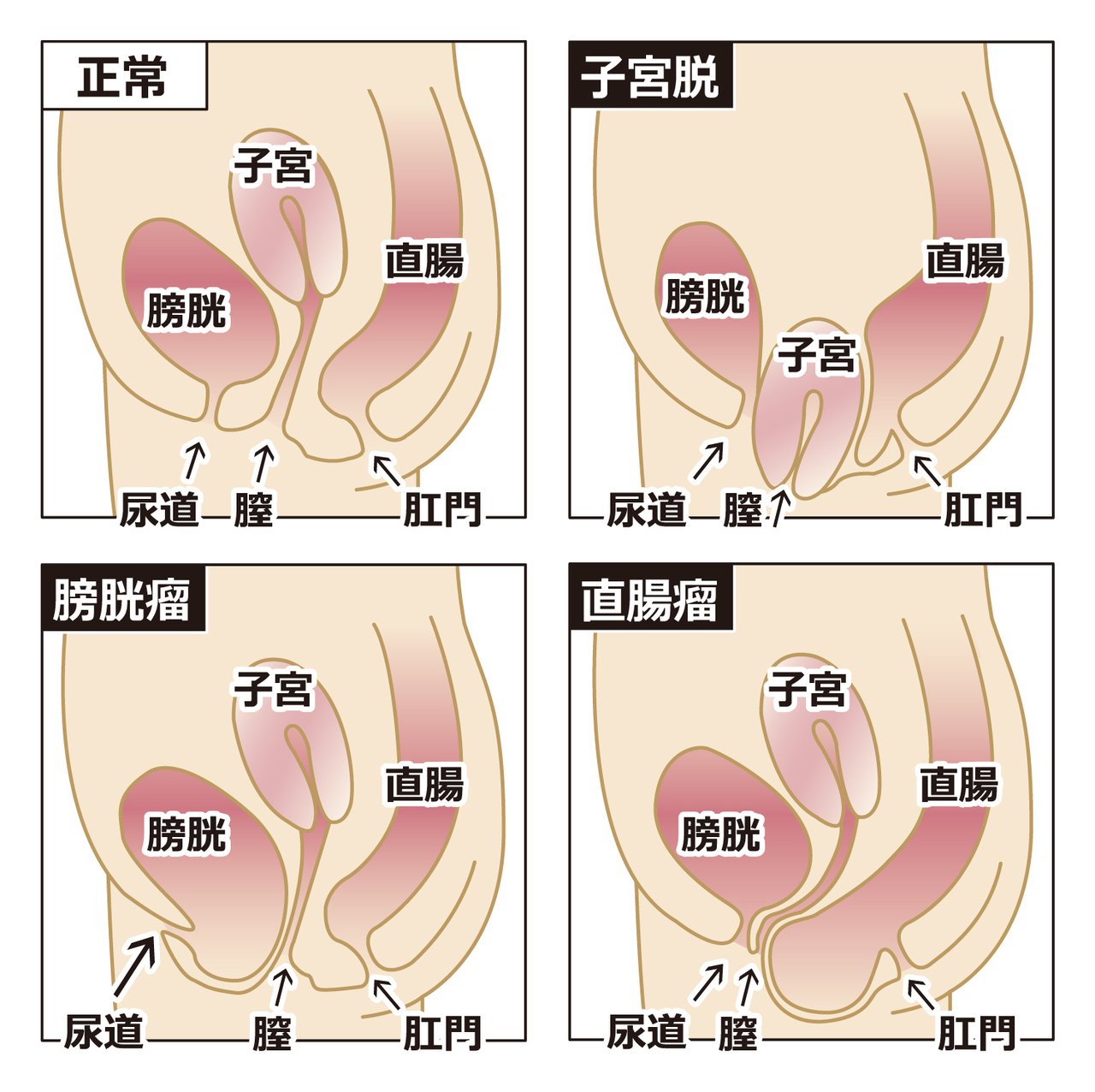 子宮脱・骨盤内臓脱